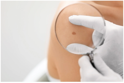 Junio, mes del cáncer de piel: protege tu piel hoy para cuidarla siempre