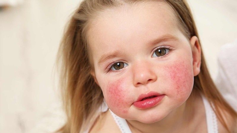 La dermatitis atópica (DA) es un trastorno, la mayoría de las veces crónico, que produce inflamación, sequedad picor i enrojecimiento. Este transtorno de la piel es conveniente tratarlo correctamente.