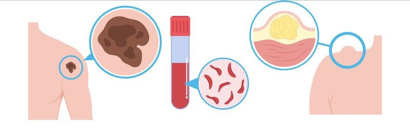 El cáncer se clasifica en función del tipo de célula a partir de la que se origina. Existen cinco tipos principales:
