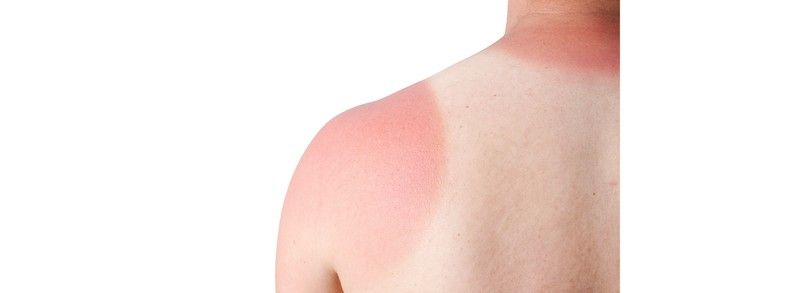 El sol puede ser causa de enfermedades graves en la piel si no nos protegemos debidamente.