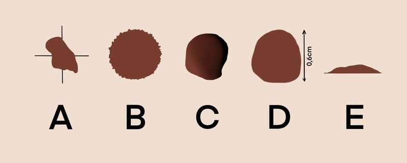 Es importante hacerse autoevaluaciones para poder detectar cualquier signo de alarma que nos haga sospechar de un melanoma, la regla del ABCDE te será muy práctica