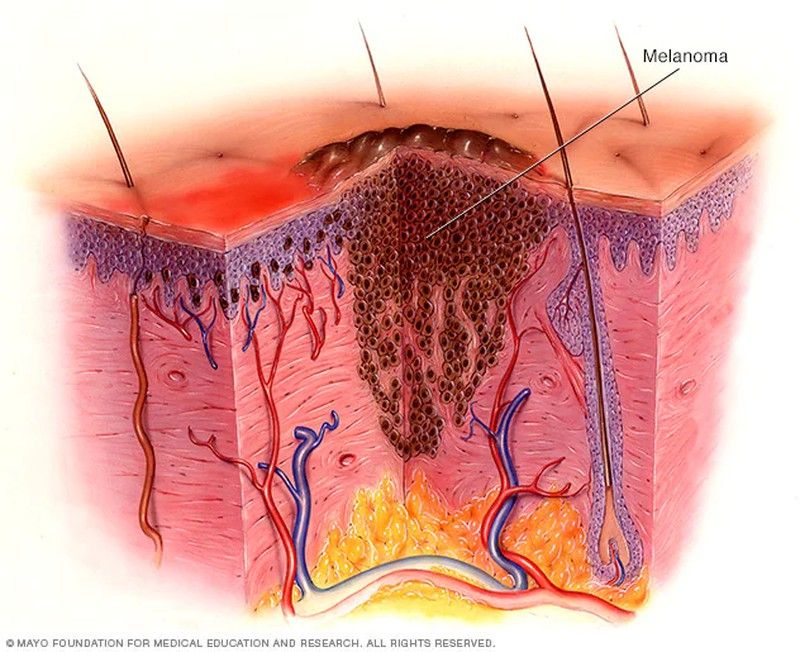 El melanoma es un tipo de cáncer de piel que se inicia cuando los melanocitos (las células que dan a la piel su color bronceado o marrón) comienzan a crecer fuera de control.