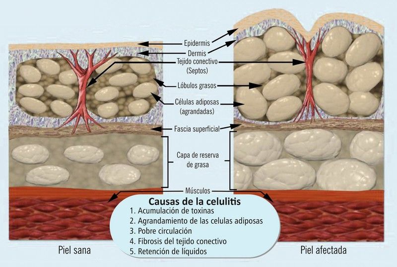 Hablamos de celulitis adiposa o coloquialmente conocida como “piel de naranja” cuando se forman abultamientos y depressiones irregulares en la superficie de la piel.